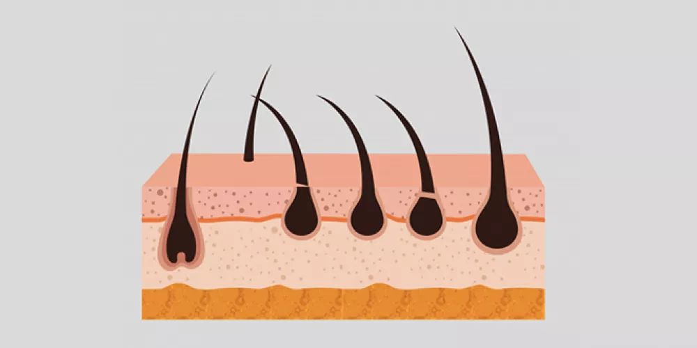 كيفية ازالة تقصف الشعر