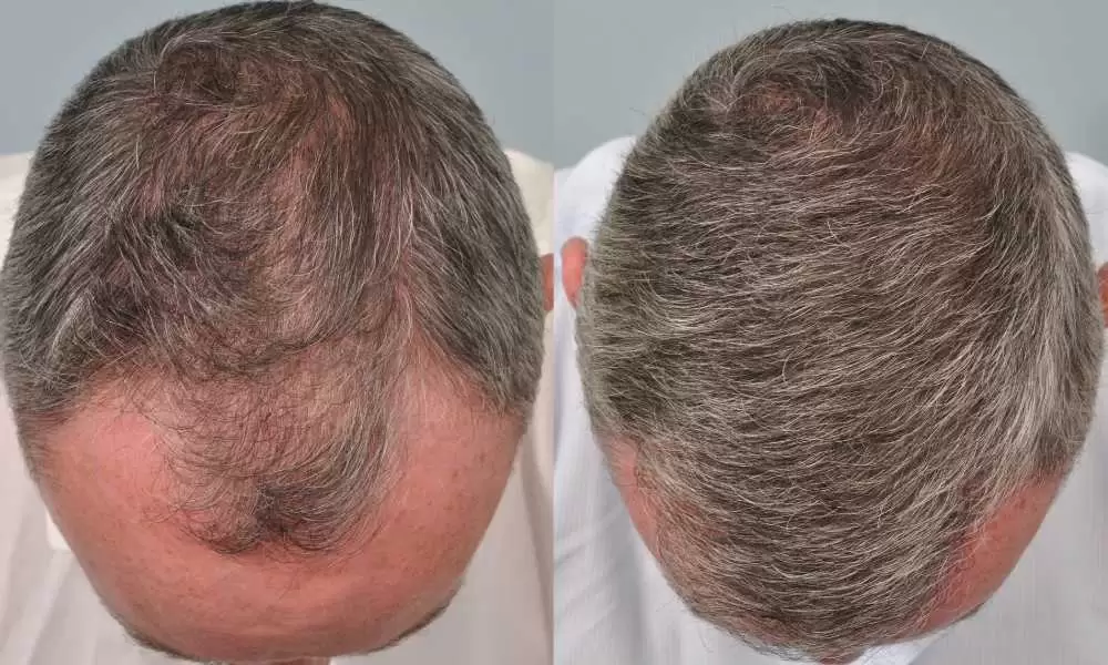 مراحل زراعة الشعر