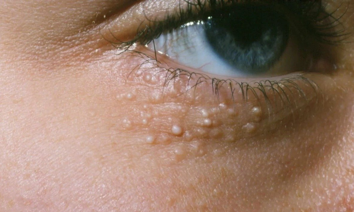 سبب ظهور حبوب بيضاء في الوجه